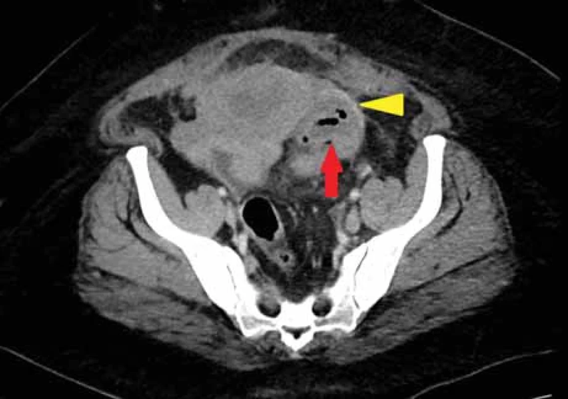 37letá pacientka 3 týdny po císařském řezu, bolesti a febrilie. V oblasti L ovaria je patrna expanze obsahující vícečetné drobné KT denzity 25 HU s bublinami plynu (červená šipka). Mezi vaječníkem a dělohou je pruhovitá struktura, která je pravděpodobně pyosalpingem (žlutá šipka). Prosáknutí okolní tukové tkáně.