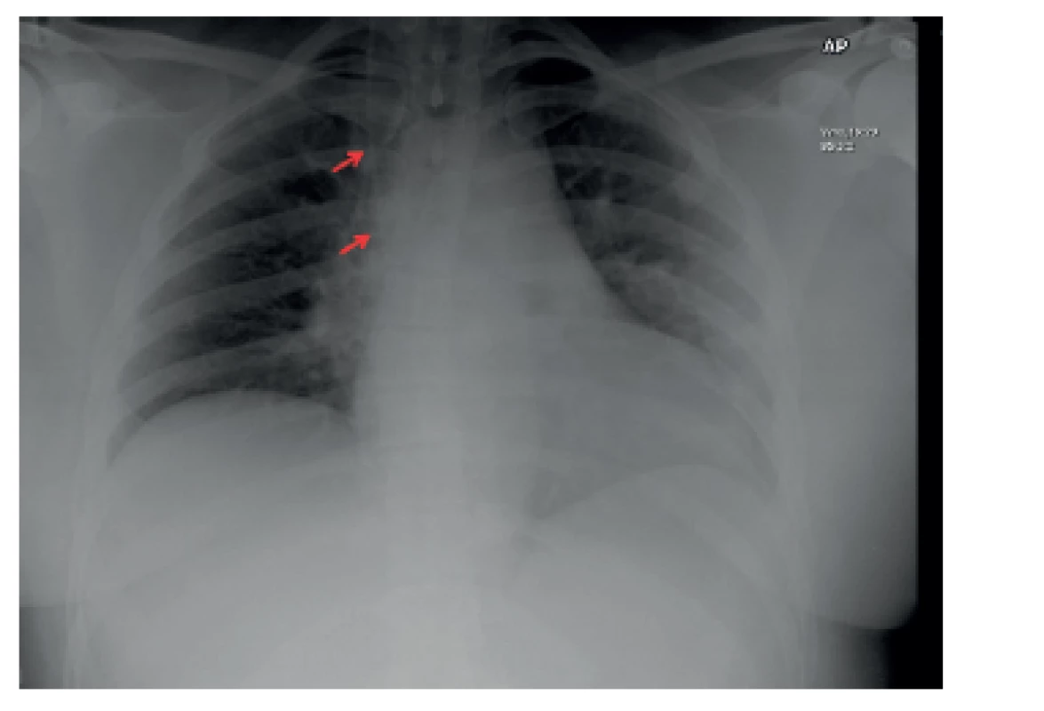 Na rentgenovém snímku pacientka se zavedeným ventrikuloatriálním shuntem (průběh označen červenými šipkami)