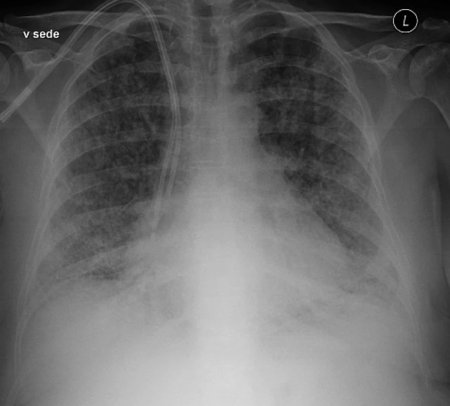 Rentgenový snímek plic s bilaterálním infiltrátem u pacienta s TRALI