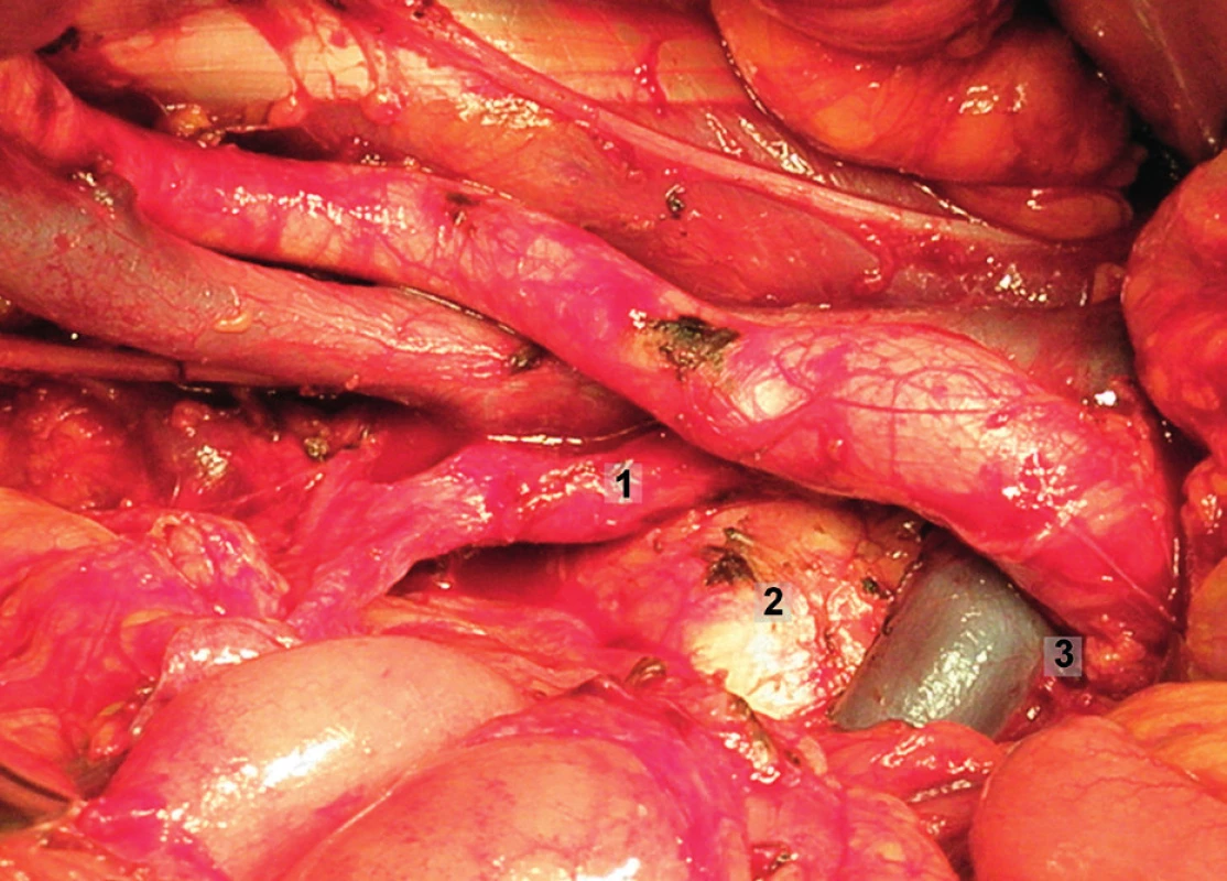 Systematická transperitoneální pánevní lymfadenektomie (pravá pánevní stěna) – sedmý krok; rektosigmoideum bylo mobilizováno anteromediálně, identifikována bifurkace aorty a průběh vnitřní ilické arterie a exstirpovány presakrální lymfatické uzliny. 1 – vnitřní ilická arterie, 2 – os sacrum, 3 – bifurkace aorty