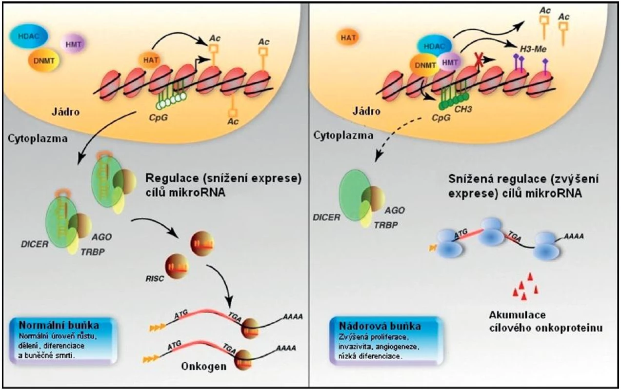 Epigenetická kontrola exprese mikroRNA. V případě normální buňky je udržována hladina onkogenu v normě působením mikroRNA (vlevo). U nádorových buněk (vpravo) může být exprese mikroRNA snížena epigeneticky metylací a ztrátou acetylace u mikroRNA genu, vedoucí k nižší regulaci cílového onkogenu a příslušného onkoproteinu, který se tak v buňce akumuluje. Upraveno podle [7].
