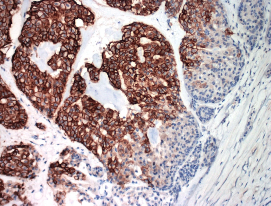 Membránová pozitivita CA IX v bunkách invazívneho duktálneho karcinómu prsníka
