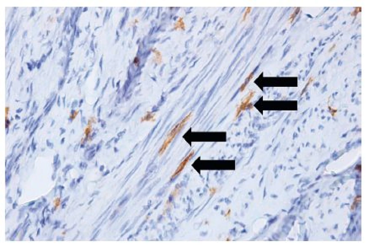 Telocyty (šípky) medzi hladkými svalovými bunkami myometria maternice (anti-CD117, vizualizované diaminobenzidínom do hneda, orig. zväčšenie 400x)