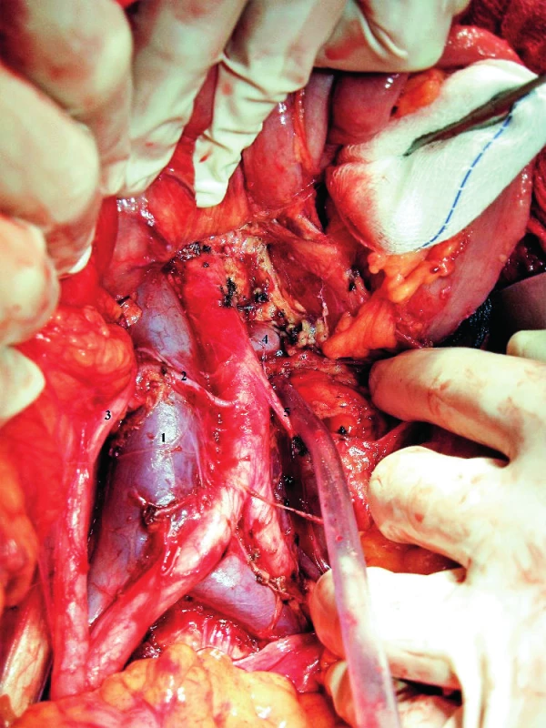 Akcesorní pravá pólová arteria renalis při současném retroaortálním průběhu levostranné vena renalis