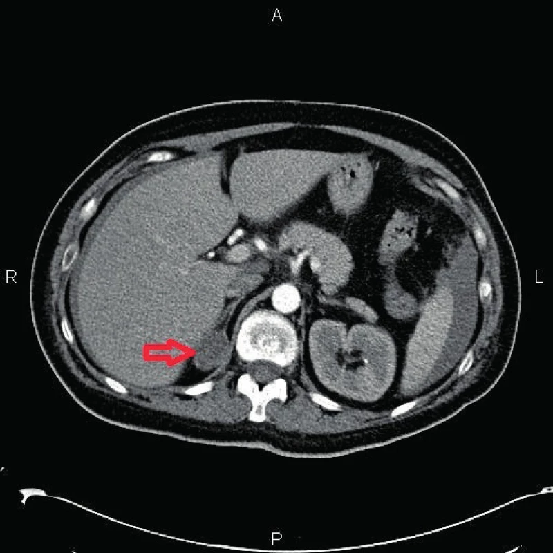 Tumor pravé nadledviny, CT scan
