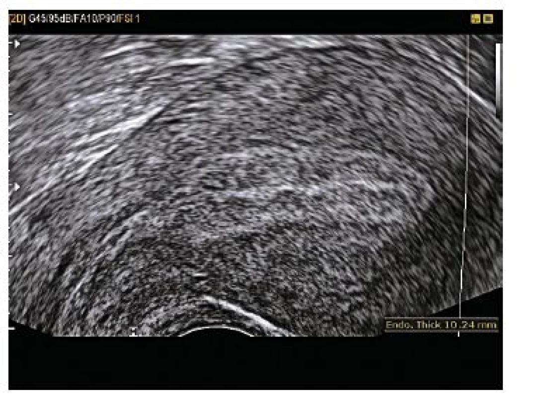 Vysoké endometrium, 10,24 mm, bez známek intrauterinní gravidity