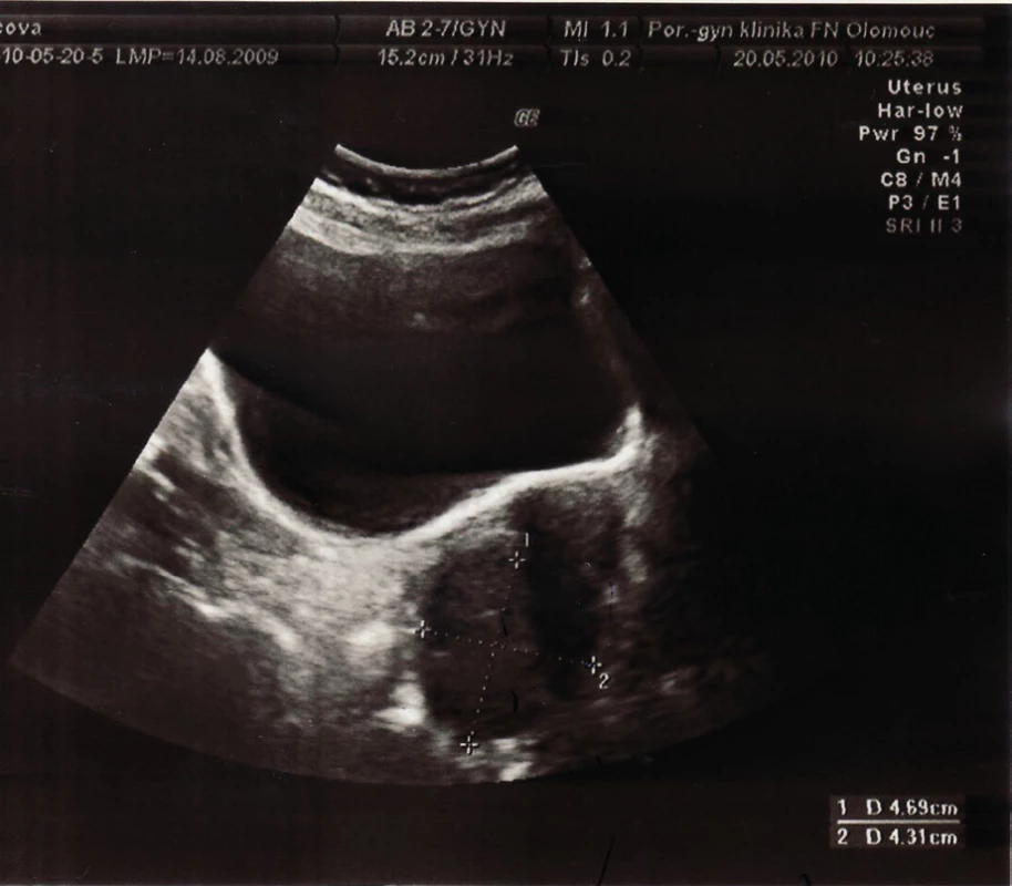 Děloha v.s. myomatózní a vpravo na dělohu nasedající oválná rezistence blíže neurčená (archivní snímek MUDr. Turkové)