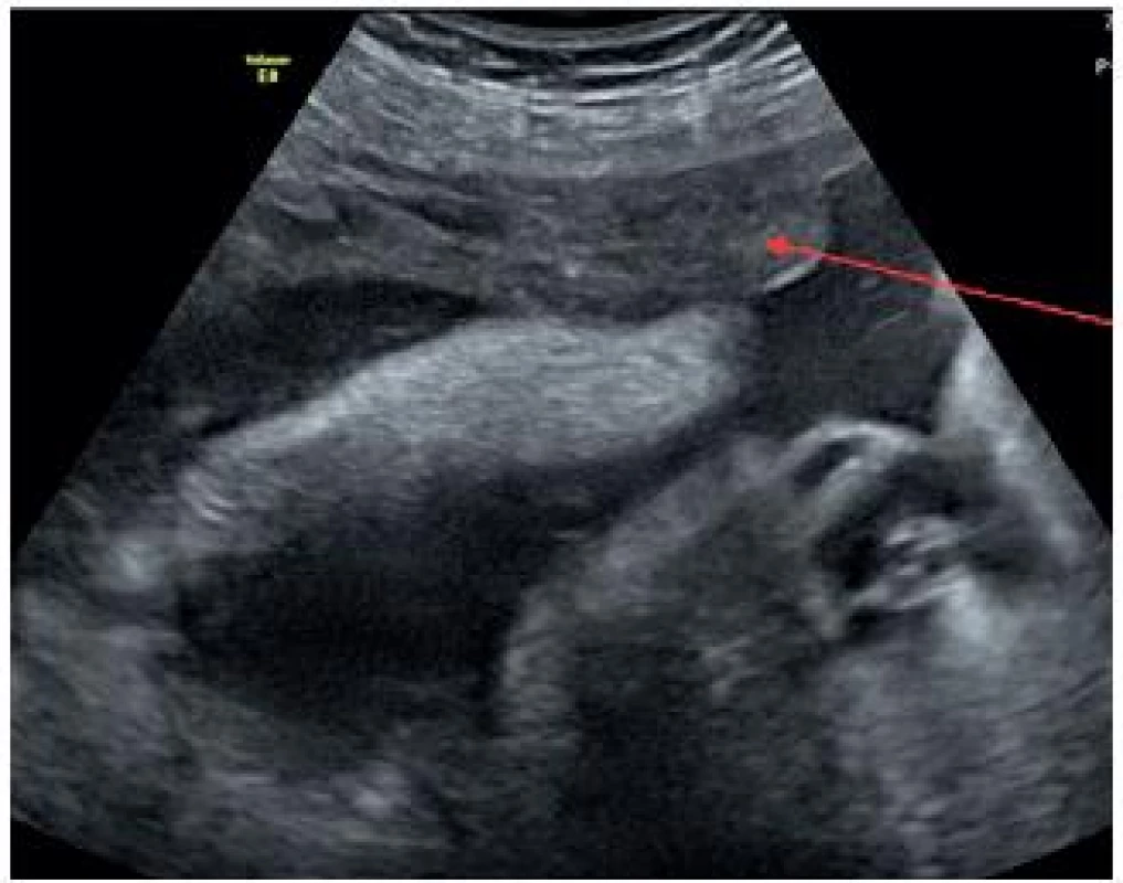 Ultrazvukové vyšetření abdominální sondou, šipkou je označena pozice vnitřní branky děložního hrdla, která se nachází přibližně v polovině vzdálenosti mezi stydkou sponou a pupkem