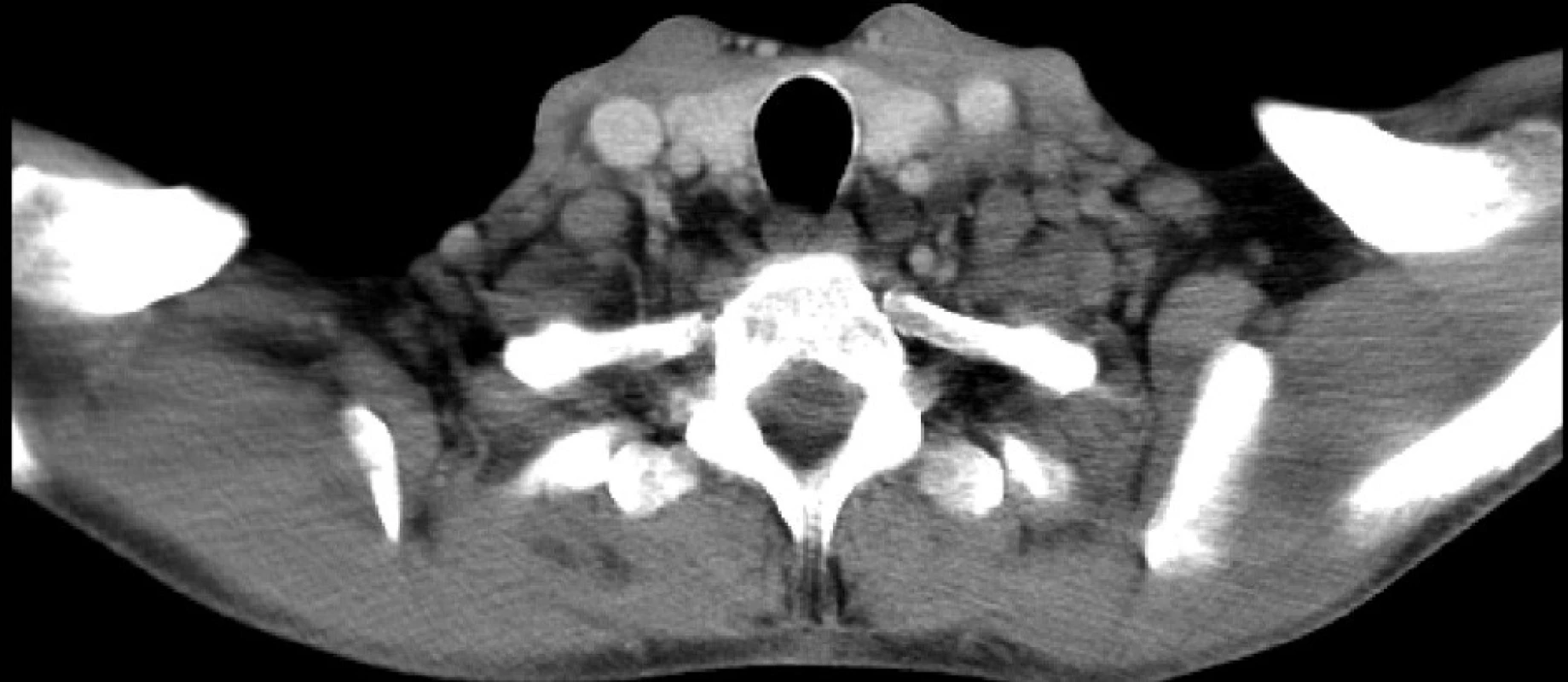 Lymfadenopatie v CT obraze – lymfom (FN Brno)