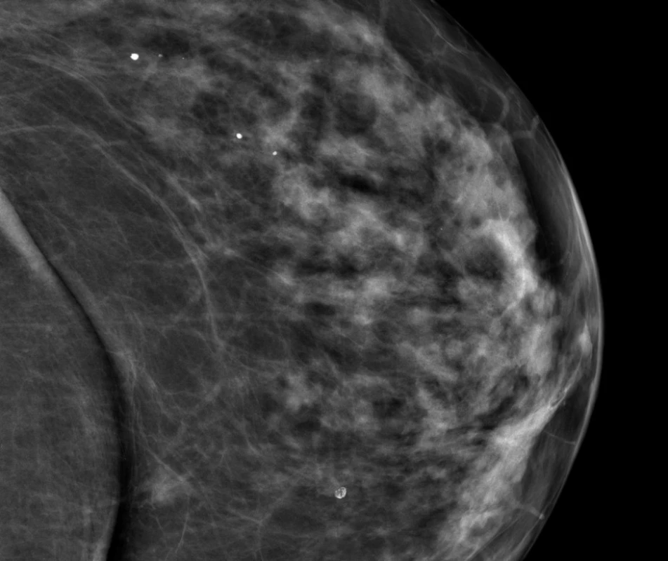 Pro nově diagnostikovaný drobný stín dorzálně ve vnitřním kvadrantu levého prsu při SGMG vyšetření v roce 2012 (obr. 9) bylo indikováno doplňující UZ vyšetření a následně core cut biopsie.