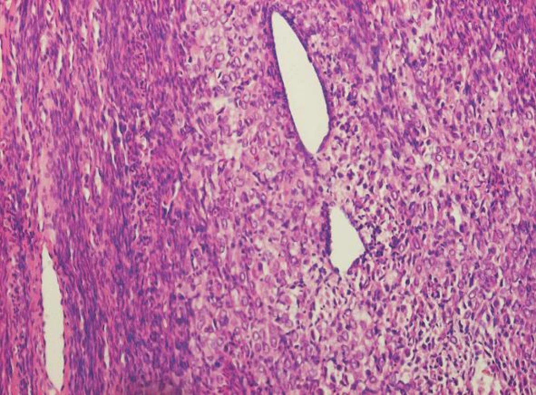 Histologický obraz myometria infiltrovaného duktálním karcinomem (HE, 4x)