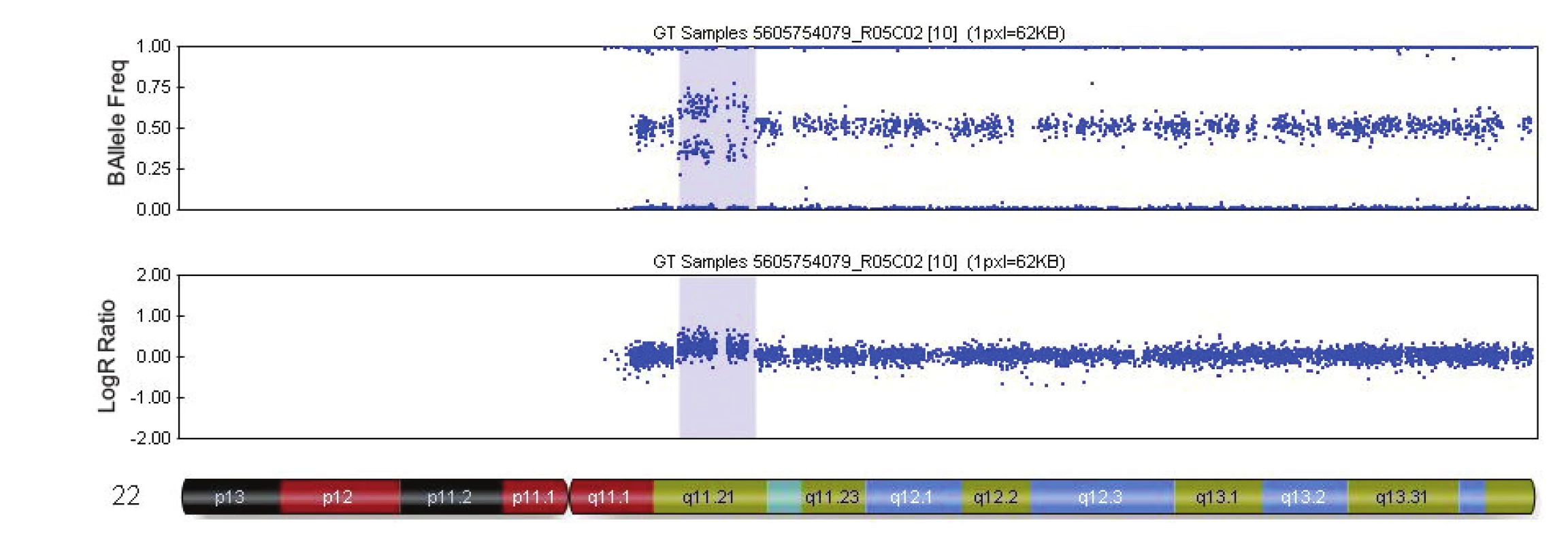 Výsledek vyšetření metodou SNP array - mikroduplikace na chromozomu 22 (případ č. 3, tab. 4). Duplikace 22q11.21 (modrý blok) o velikosti 2.9 Mb u plodu s agenezí corpus callosum. Duplikace překrývá oblast pro tzv.22q11.21 mikroduplikační syndrom.
Zdroj: Illumina GenomeStudioV2010.2 / Chromosome Browser