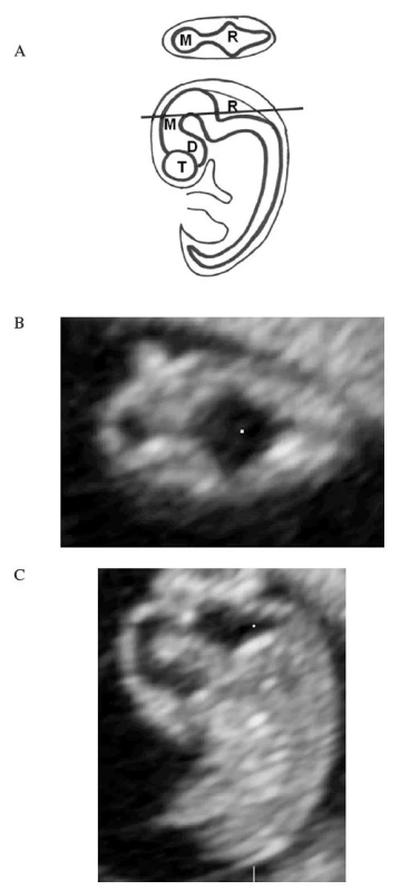 CNS u embrya 8. gestačního týdne v mediosagitálním a transverzálním řezu vedeném v úrovni naznačené linie. Schéma (A), ultrasonografický korelát (B, C). CRL = 13,5 mm.
T – telencefalon, D – diencefalon, M – mezencefalon, R – rombencefalon
