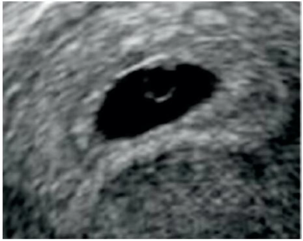 Intrauterinní těhotenství v polovině 6. gestačního týdne
Ultrazvukové zobrazení gestačního váčku o průměru 7,7 mm (odpovídá grav. hebd. 5+2) se sekundárním žloutkovým váčkem, který má pravidelný kulovitý tvar a je přitištěn k okraji.