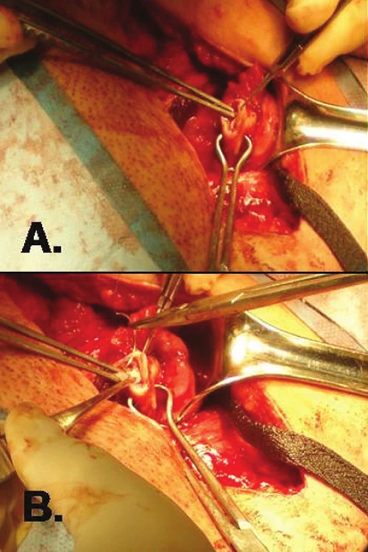 Transplantace proužků ovariálního kortexu přímo do ovaria (použito se svolením dr. Ariela Revela, Hadassah Medical Center, Jerusalem, Israel)
A. vytvoření incize v kortexu ovaria; B. vložení proužku ovariálního kortexu a sutura incize