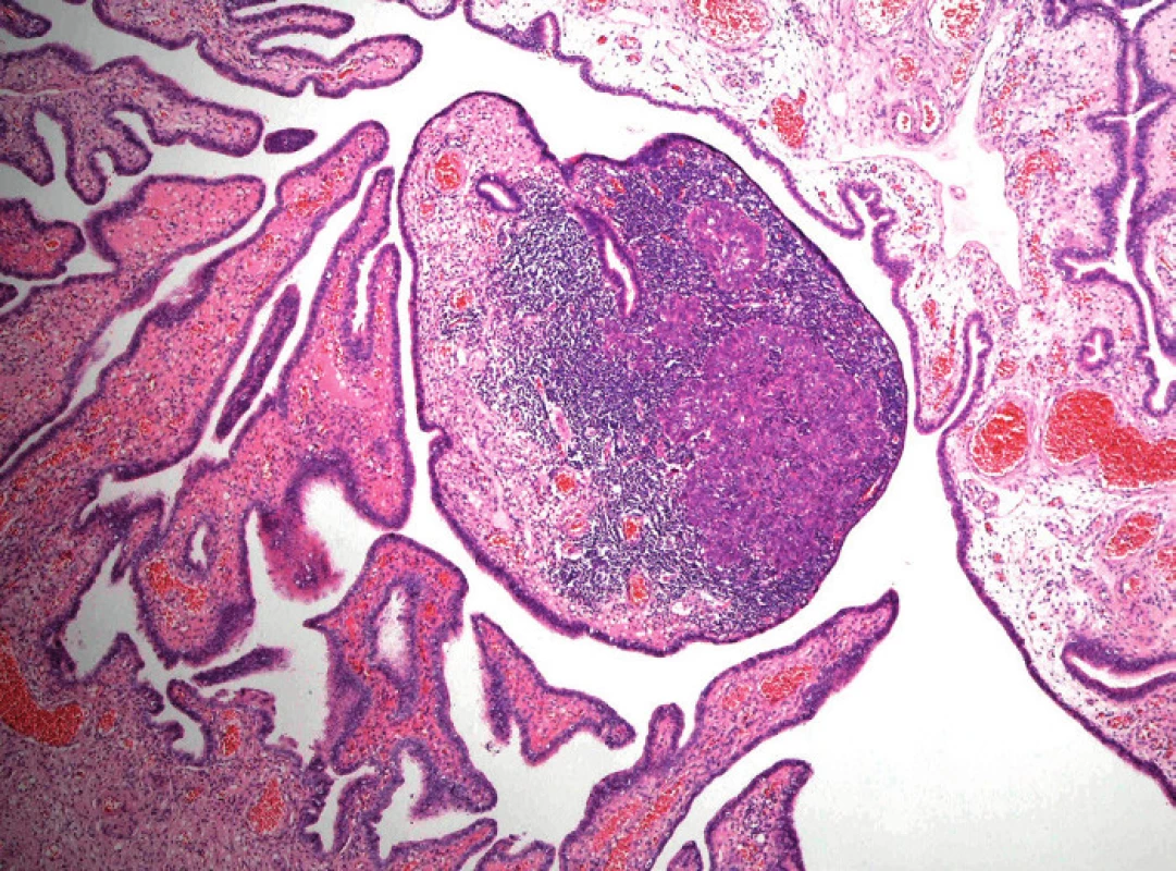 Drobné ložisko průměru 0,6 mm nízce diferencovaného (high-grade) serózního adenokarcinomu ve sliznici fimbriální části tuby jako náhodný mikroskopický nález u 40leté ženy se zárodečnou mutací genu BRCA1. V okolí nádorového ložiska je intenzivní zánětlivý infiltrát (hematoxylin-eozin, původní zvětšení 40×)