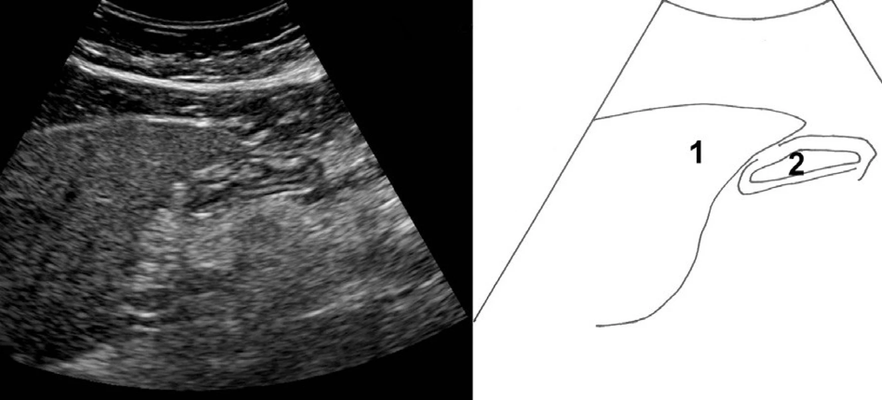 Příčný řez epigastriem mírně vlevo od střední čáry. 1 – levý lalok jater, 2 – žaludek
