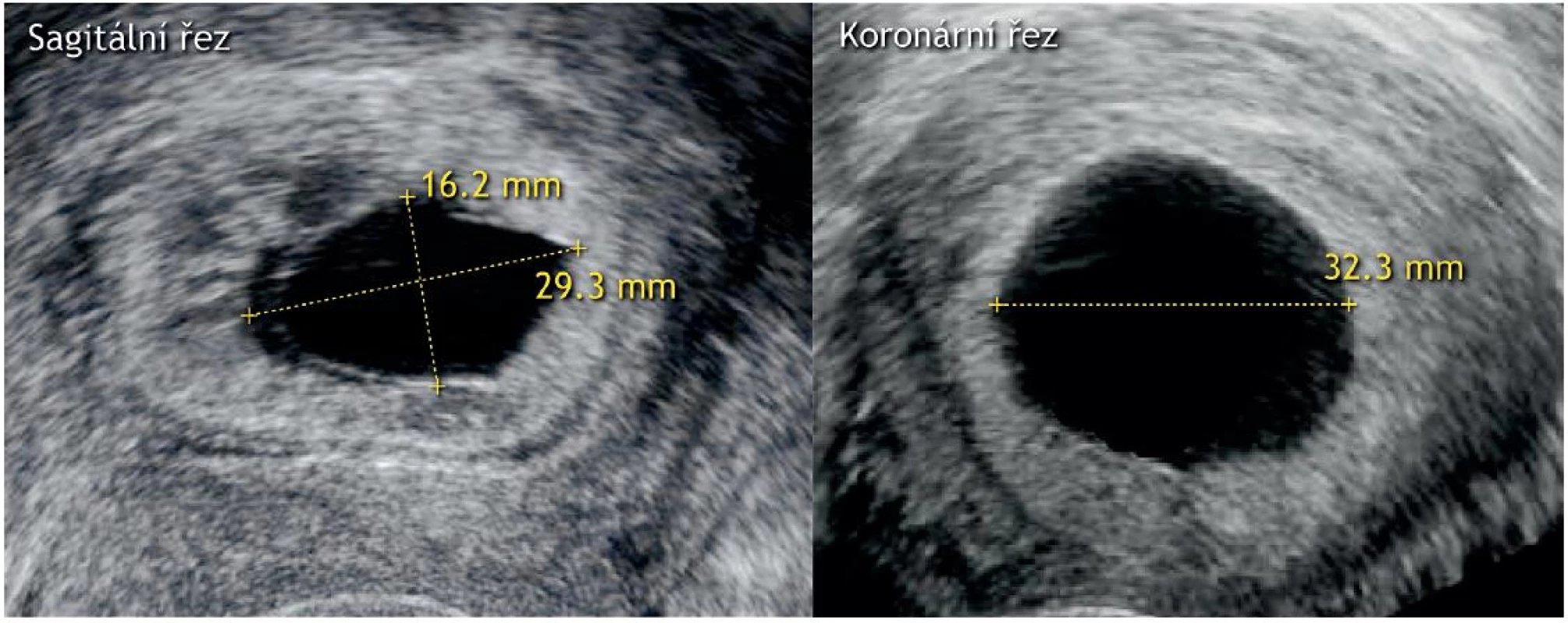 Průkaz neprosperující itrauterinní gravidity (průměrná velikost gestačního váčku ≥ 25 mm bez prokazatelného embrya)
Ultrazvukové zobrazení gestačního váčku bez embrya se srdeční akcí a v tomto případě i bez sekundárního žloutkového váčku o průměrné velikosti 25,9 mm (v sagitálním řezu: kraniokaudální rozměr 16,2 mm a anteroposteriorní 29,3 mm, v koronárním řezu: laterolaterální rozměr 32,3 mm).