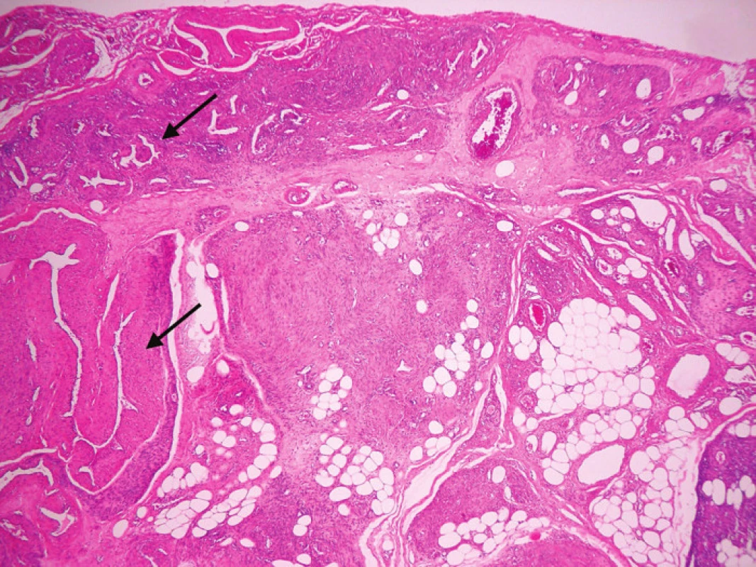 Histologický vzhľad angiolipoleiomyómu s charakteristickými tkanivovými komponentmi. Šípkami označené anomálne cievy. Farbenie HE, zväčšenie 40x