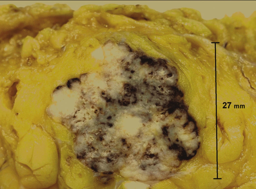 Necharakteristická makroskopie ukazující ostře ohraničený tumor v tukově atrofické mléčné žláze s bodovými ložisky nekróz a hemoragií