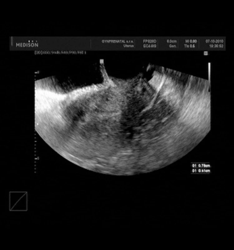 Suspektní ultrazvukový nález u postmenopauzální pacientky byl indikací k hysteroskopii prokazující téměř kompletní plošný adhezivní proces, se zachovanou pouze malou částí intaktní dutiny děložní u tubárního ústí (viz anechogenní útvar ve fundu děložním)