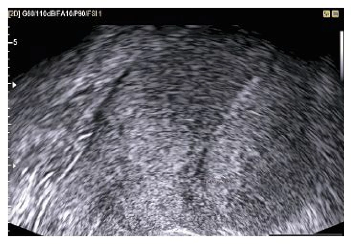 Endometrium nízké 4,12 mm, bez známek intrauterinní gravidity. Na přední stěně děložní patrná jizva po sectio caesarea