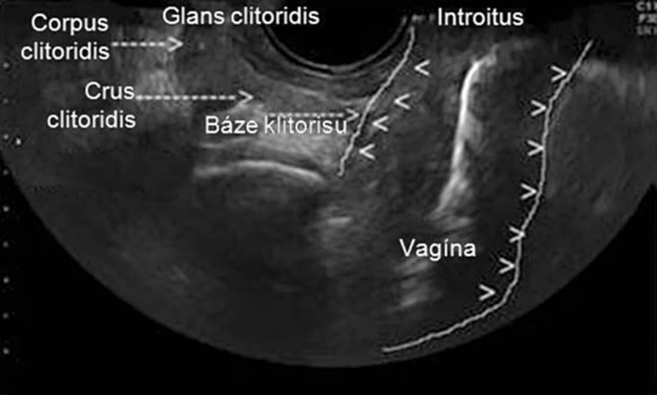 Sonografické znázornění vztahu báze klitorisu a přední stěny vaginy v sagitální rovině (zdroj: Foldes, P., Buisson, O. The clitoral complex: a dynamic sonographic study. J Sex Med, 2009, 6, p. 1223–1231)