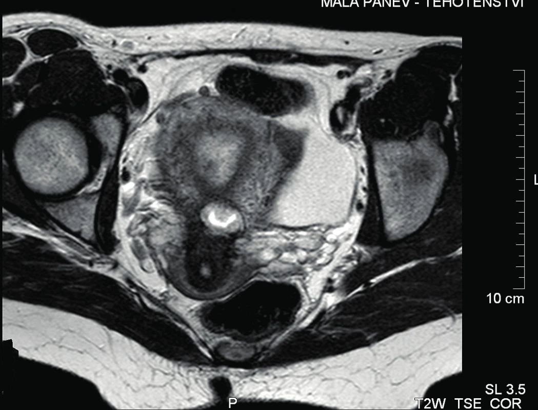MRI malé pánve – transverzální řez