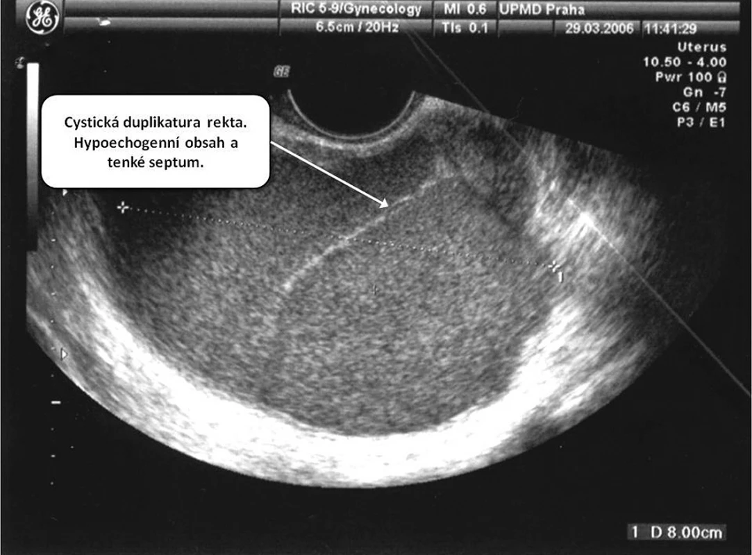 Ultrazvukový obraz cystické expanze v malé pánvi vlevo za dělohou o průměru 8 cm