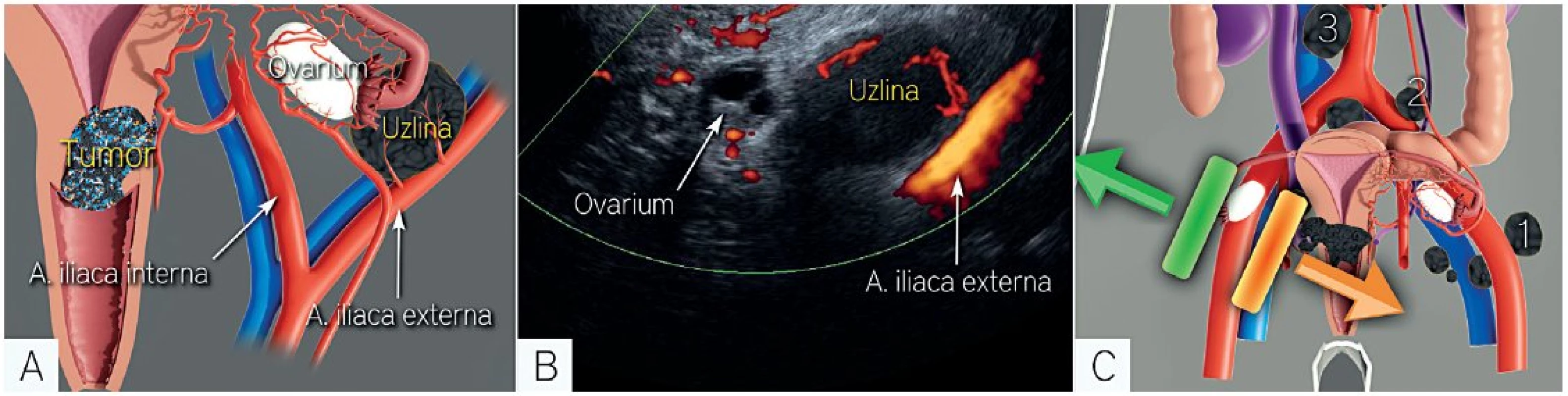 Vyšetření lymfatických uzlin (kombinace transvaginálního a nebo transrektálního ultrazvukového vyšetření s transabdominálním ultrazvukem)