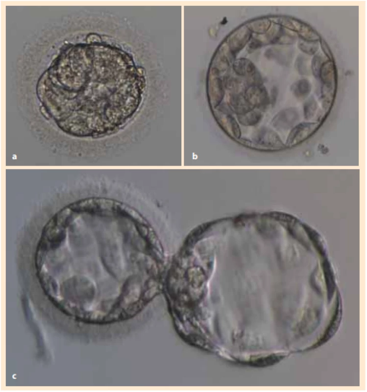 Příprava darovaných embryí před izolací embryoblastu a následnou 
kultivací buněčné linie hESC: a) embryo po rozmrazení ve stadiu moruly, 
b) blastocysta po dokultivování, c) blastocysta s provedeným asistovaným 
hatchingem.<br>
Fig. 1. Preparation of donated embryos before embryoblast isolation and subsequent cultivation of the hESC cell line: a) embryo after thawing in the morula 
stage, b) blastocyst after recultivation, c) blastocyst with assisted hatching.