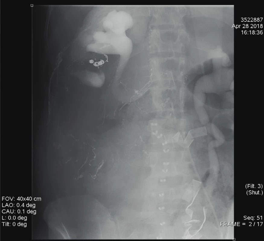 Nativní snímek břicha: na snímku je patrná kontrastní
náplň kalichopánvičkového systému obou ledvin, vpravo ureter
nenaplněn, vlevo s náplní; dále je patrný embolizační materiál
(koily a lepidlo) v oblasti tumoru [6]