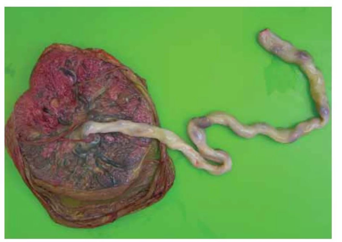 Placenta vcelku z fetální strany, zde je viditelné jen mírné zakalení plodových
obalů a malá depozita fibrinoidu pod choriovou ploténkou.<br>
Fig. 1. Entire placenta from the fetal side. There is visible only a slight clouding
of the fetal membranes and imperceptible fibrin deposition under the chorionic
disc.