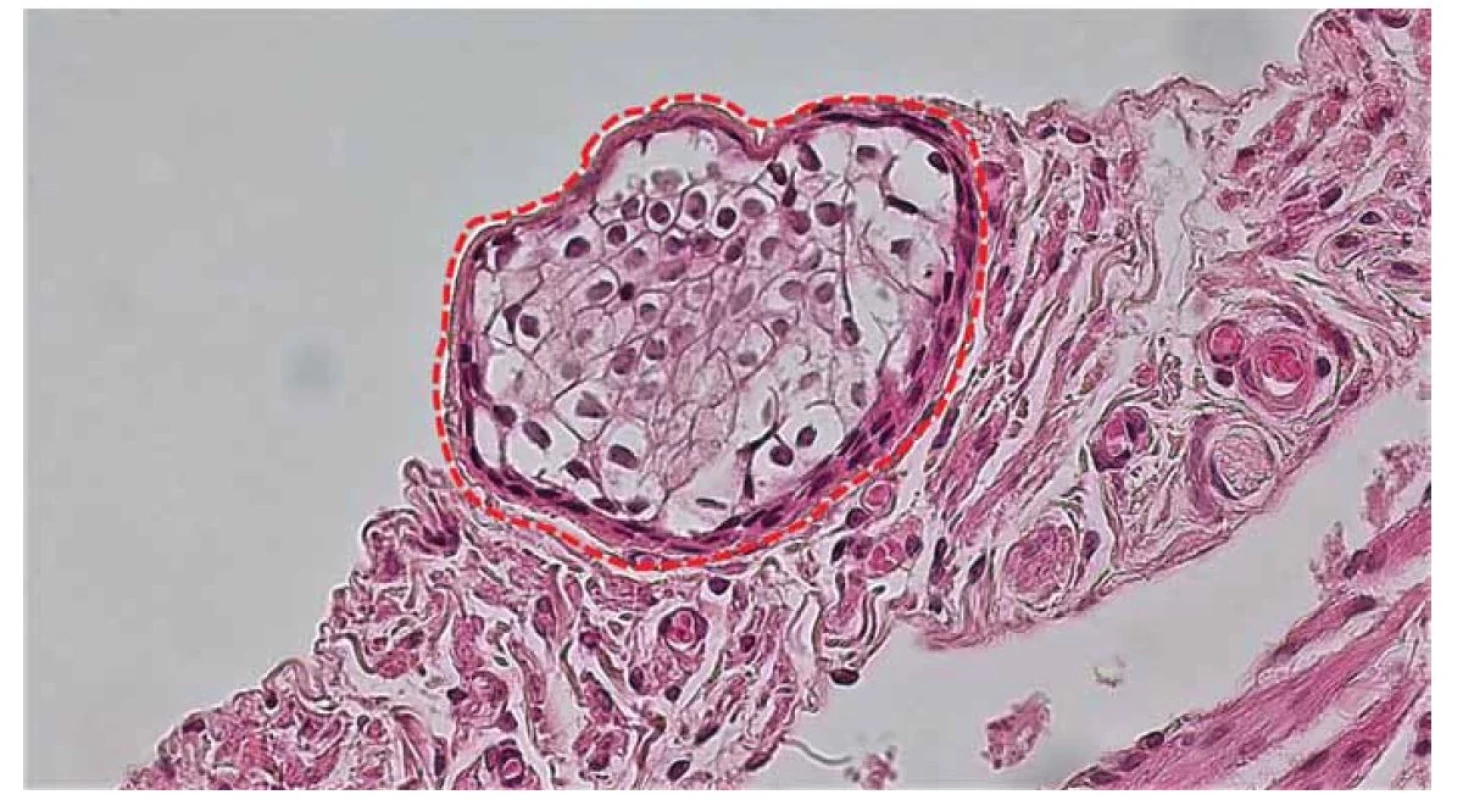 Detail serózy vajíčkovodu. Zhluk epitelových buniek označovaných ako Walthardove bunkové hniezda (červená
prerušovaná čiara).<br>
Fig. 7. Detail of fallopian tube serosa. A cluster of epithelial cells referred to as Walthard's cell nests (red dashed line).