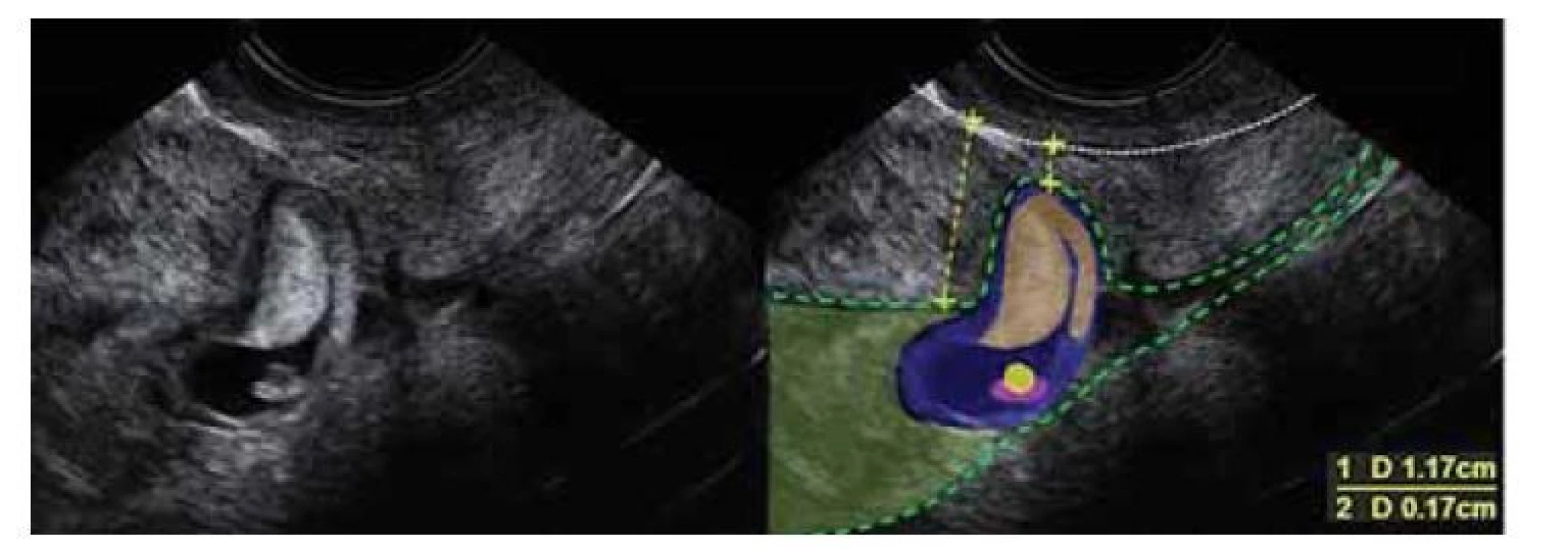 Ultrazvukový nález gravidity gestačního týdne 6+2 v jizvě děložní.
Atypicky nízko lokalizovaná gravidita. Prázdná horní polovina dutiny děložní.
Ztenčelé myometrium v místě nidace plodového vejce. Standardní tlouštka
stěny 1,7 cm, ztenčelé myometrium jizvě 1,7 mm. Patrné tvořící se chorion
frondosum v místě jizvy.<br>
Fig. 2. Ultrasound finding of gestational week 6+2 pregnancy in a uterine scar.
Atypically low localized pregnancy. The empty upper half of the uterine cavity.
Thinned myometrium at the site of fetal egg nidation. Standard wall thickness is
1.7 cm, and thinned myometrium scar is 1.7 mm. Noticeable chorion frondosum
forming at the site of the scar.