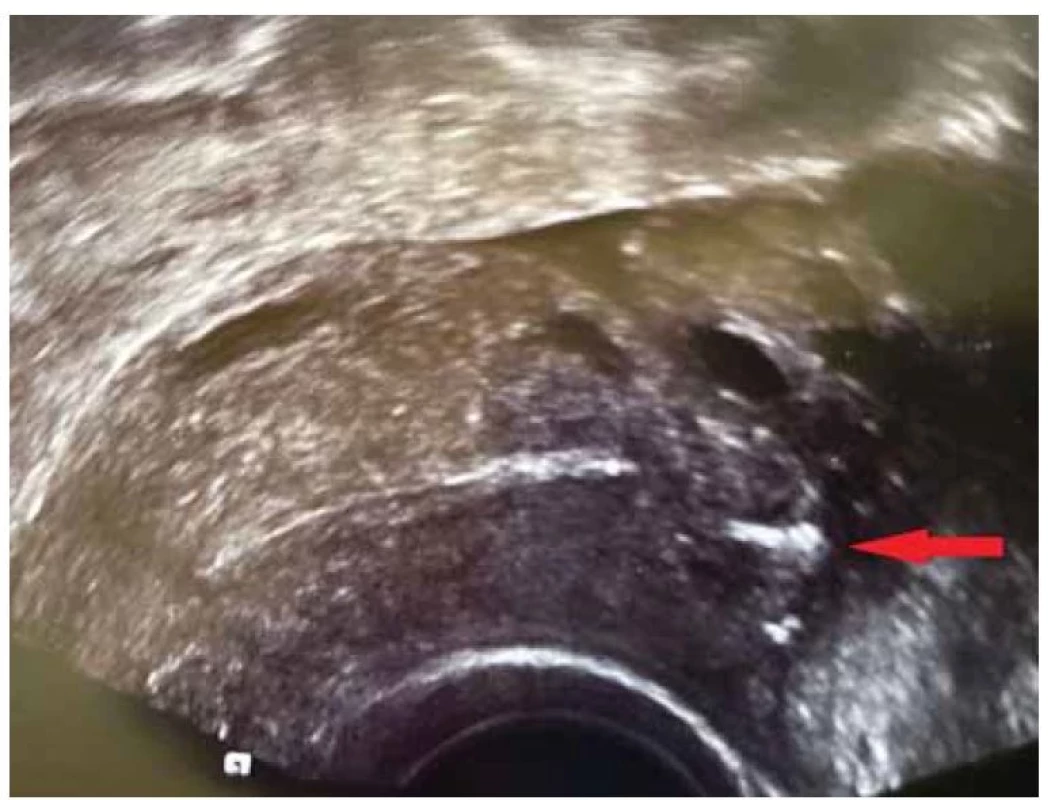 Kontrolní ultrazvuk po operaci (šipkou zobrazen steh).<br>
Fig. 3. Control ultrasound after surgery (stitch shown by arrow).