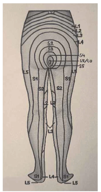 Dermatomy dolních končetin,
pohled zezadu.<br>
Fig. 2. Dermatomes of the lower limbs,
rear view.