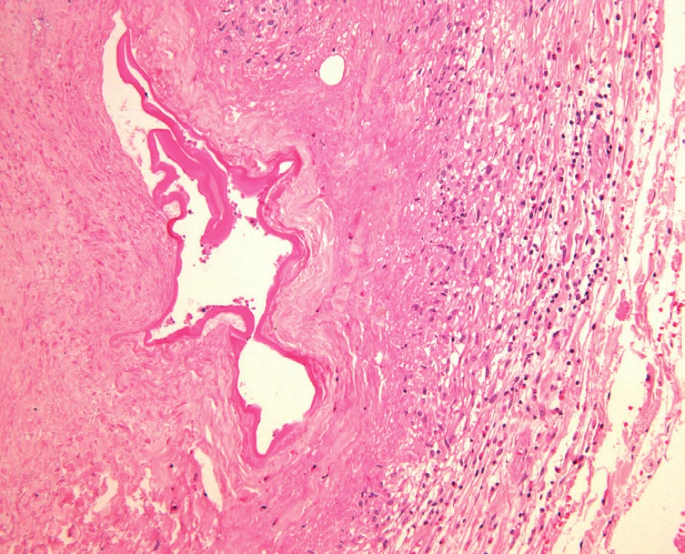 Histopatologie: kolabovaná echinokoková cysta s demarkační linií fibroplastických změn, v okolí reziduální zánětlivá reakce; barvení HE, zvětšení 400krát