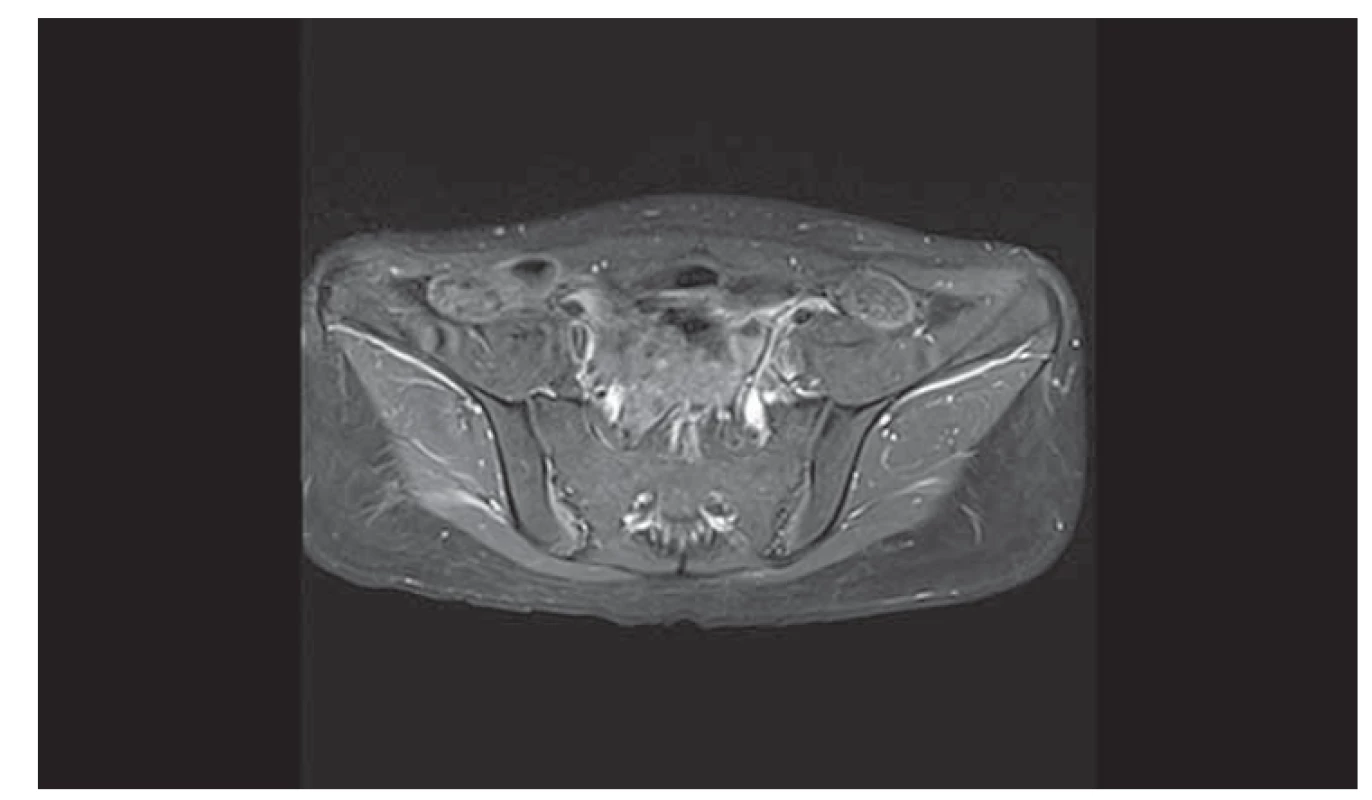 Vyšetření pánve magnetickou rezonancí (T1 sekvence) zobrazuje cystu
pravého ovaria.<br>
Fig. 1. Examination of the pelvis by magnetic resonance (T1 sequence) showing a
cyst of the right ovary.