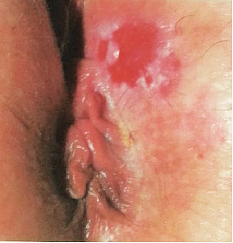 Extramamární Pagetova chroroba (foto autor) je vzácný
karcinom. Postiženy bývají především lokality s apokrinními
žlázami. Pagetova choroba vulvy tvoří méně než 1 % všech
maligních tumorů vulvy. Jedná se o nádor epitelu vývodů
potních žláz s prorůstáním do epidermis. Klinicky se onemocnění
projevuje jako dosti ostře ohraničené většinou erytémové ložisko
s povrchovými erozemi nebo s keratózou. Někdy může mít vzhled
ekzému s hyperpigmentovanými nebo depigmentovanými okrsky.