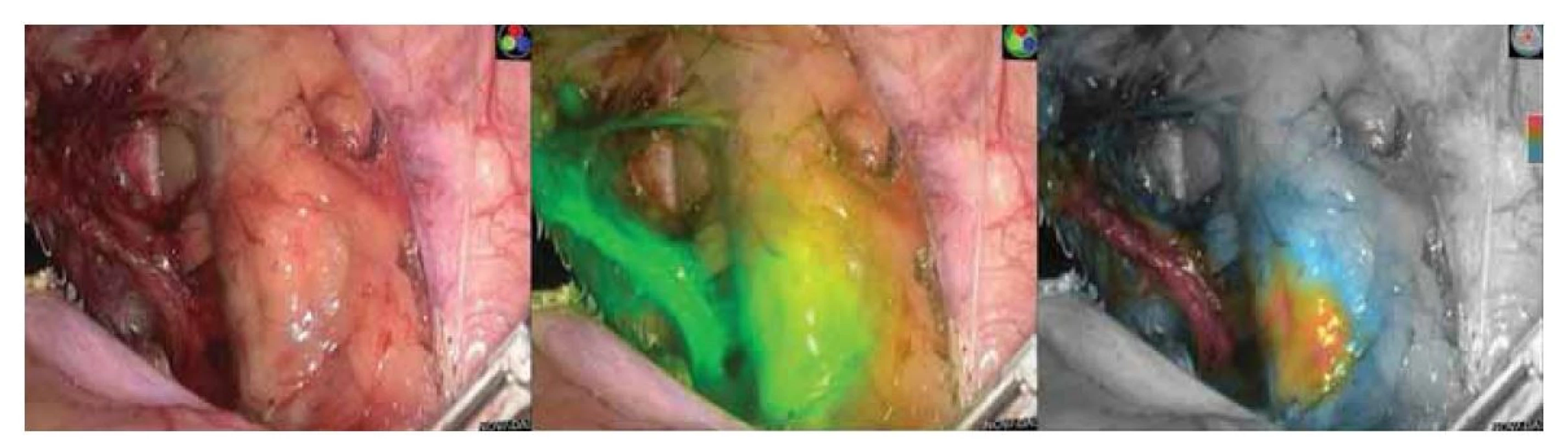 Ukázka laparoskopické detekce indocyaninového zeleného barviva pomocí systému Novadaq. Obrázek vlevo s
klasickým laparoskopickým obrazem, uprostřed v real-time detekčním módu, vpravo v real-time kvantifikačním módu.<br>
(Zdroj: Gynekologicko-porodnické oddělení, Nemocnice Nový Jičín AGEL a.s.).<br>
Fig. 1. Demonstration of laparoscopic detection of indocyanine green dye using the Novadaq system. Image on the left with
a classic laparoscopic image, in the middle in real-time detection mode, and on the right in real-time quantification mode.<br>
(Source: Department of Gynecology and Obstetrics, Hospital Nový Jičín AGEL a.s.).