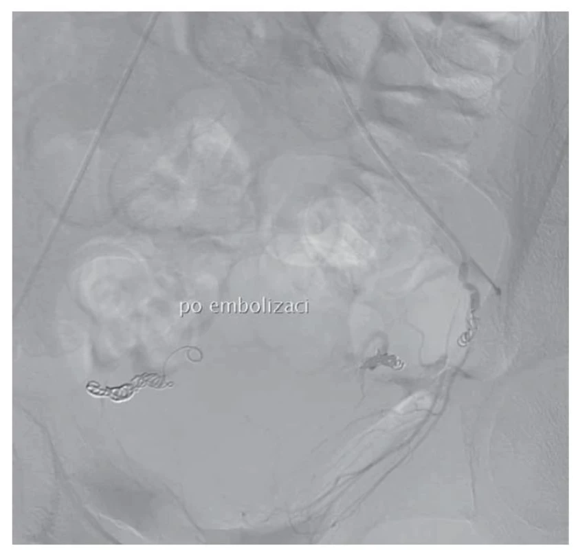 Snímek po provedené UAE.<br>
UAE – embolizace uterinních tepen<br>
Fig. 5. Image after the performed UAE.