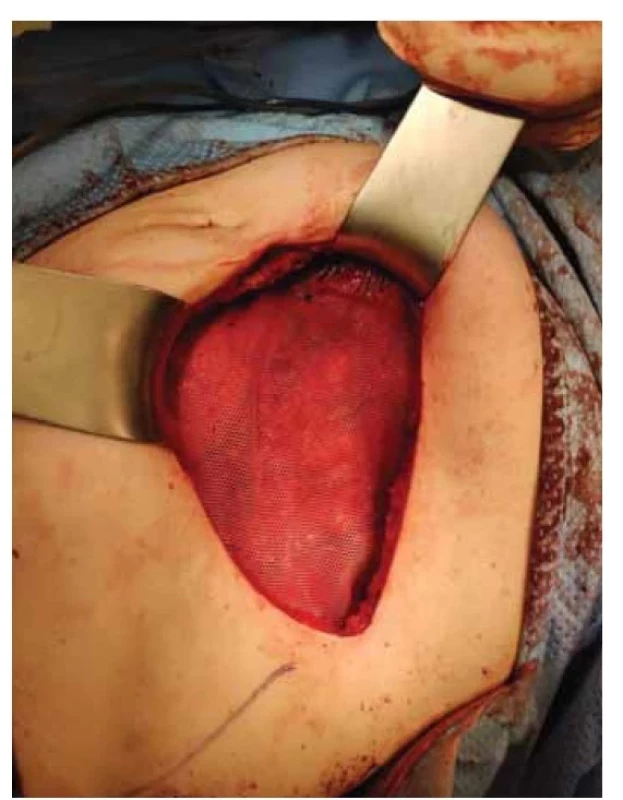 Defekt břišní stěny krytý chirurgickou síťkou.<br>
Fig. 3. Defect of the abdominal wall covered by a surgical
mesh.