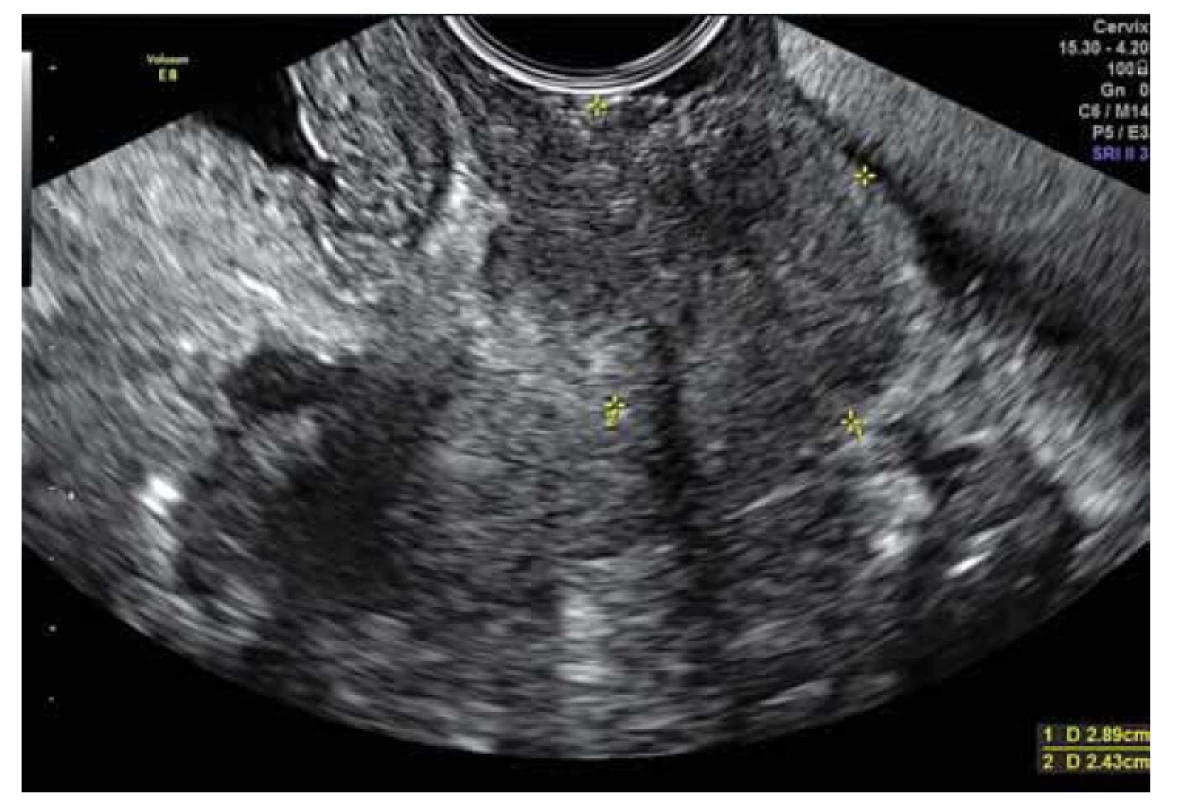 Ultrazvukový nález – 1. měsíc užívaní antituberkulotik, žlutě označen
cervix.<br>
Fig. 3. Ultrasound finding – 1st month of antituberculosis treatment,
yellow marks – cervix.