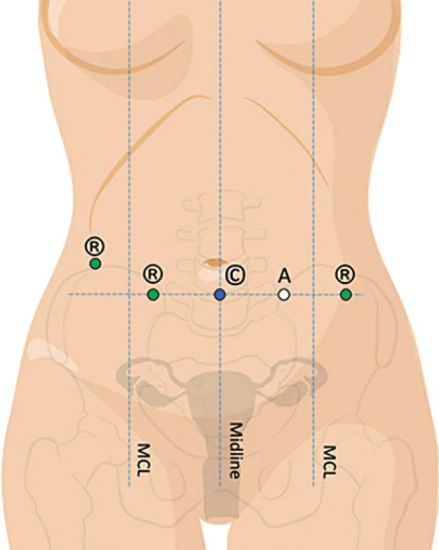 Duální dokování – rozmístění vstupů do břišní dutiny
při využití jednoho vstupu pro optiku (upraveno podle Intuitive
Surgical, H. Falconer)