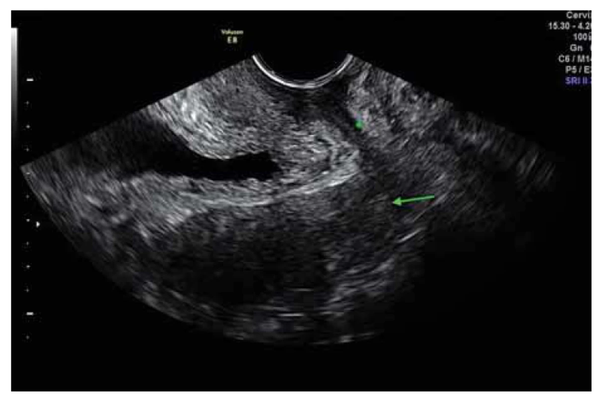 Ultrazvukový nález – 4. měsíc užívaní antituberkulotik, hvězdička –
synechie pochvy, šipka – cervix.<br>
Fig. 5. Ultrasound finding – 4th month of antituberculosis treatment, star – vaginal
synechiae, arrow – cervix uteri.