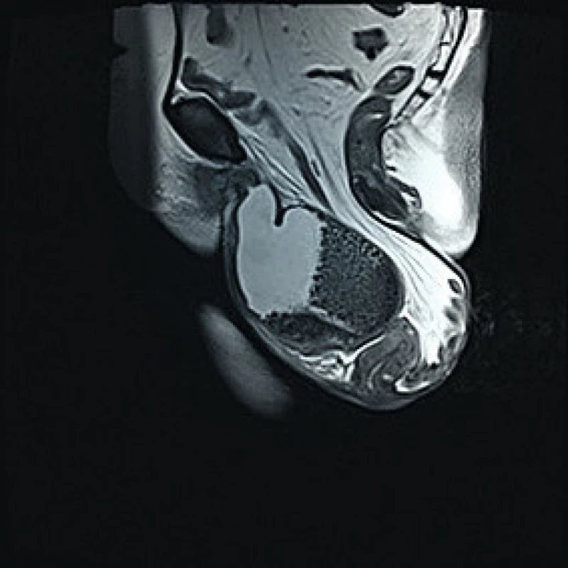 Prolaps a konkrementy močového měchýře na vyšetření
magnetickou rezonancí