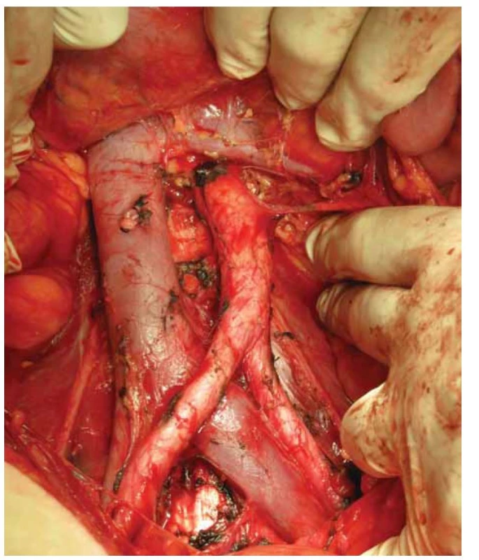 Retroperitoneum po provedené pánevní a paraaortální lymfadenektomii
po úroveň levé renální žíly.<br>
Fig. 3. Retroperitoneal space after pelvic and paraaortic lymphadenectomy to the
level of the left renal vein.
