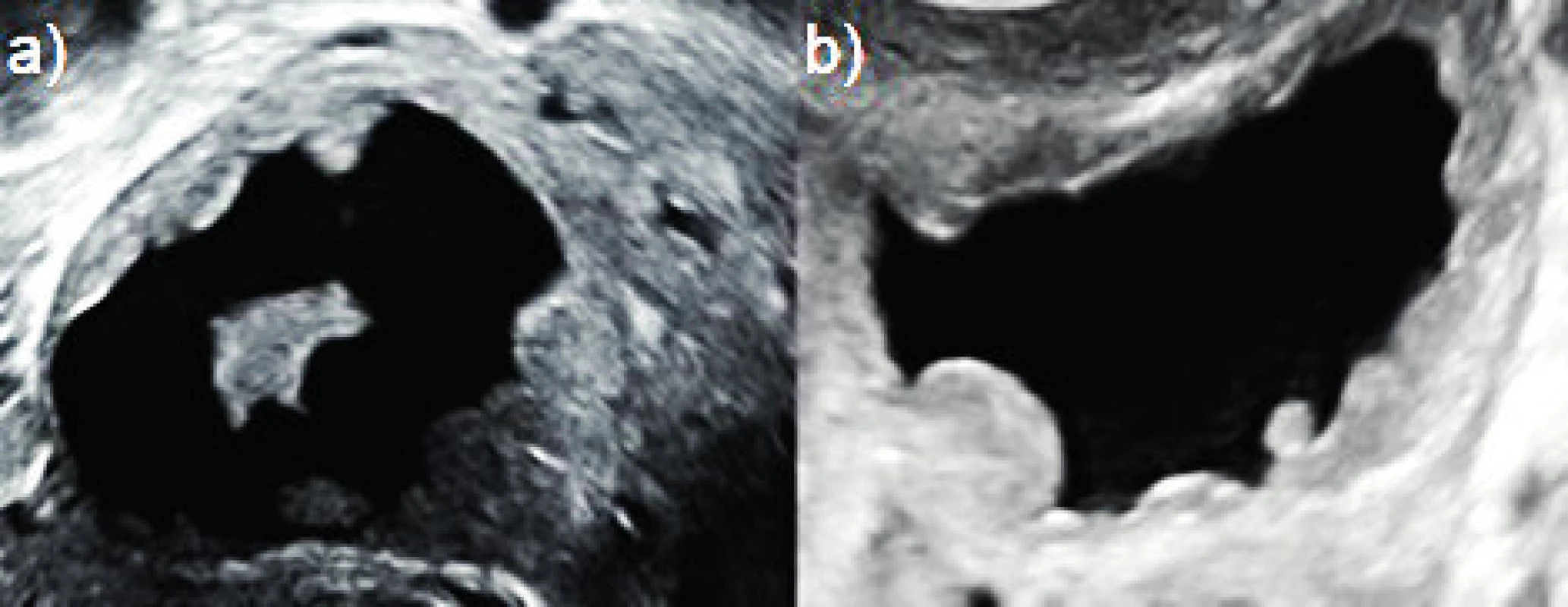 Decidualizované endometroidní cysty<br>
(a–b) unilokulární solidní tumory, intracysticky hypoechogenní
obsah, vnitřní výstelka cyst je pokryta papilaritami, které jsou oblé
a pravidelné s hladkým povrchem, v obou případech byly tumory
sledovány během těhotenství až do spontánní regrese solidních porcí
po šestinedělí.