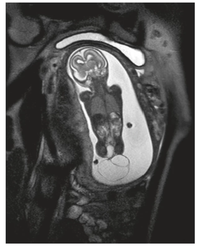 Magnetická rezonance v 18. gestačním týdnu (řez
s patrnými cystami uvnitř nádoru)